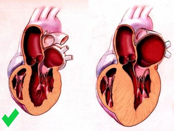 A Cardione megakadályozza a szív kamrai hipertrófiáját